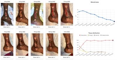 Implementation of a patient-centered remote wound monitoring system for management of diabetic foot ulcers